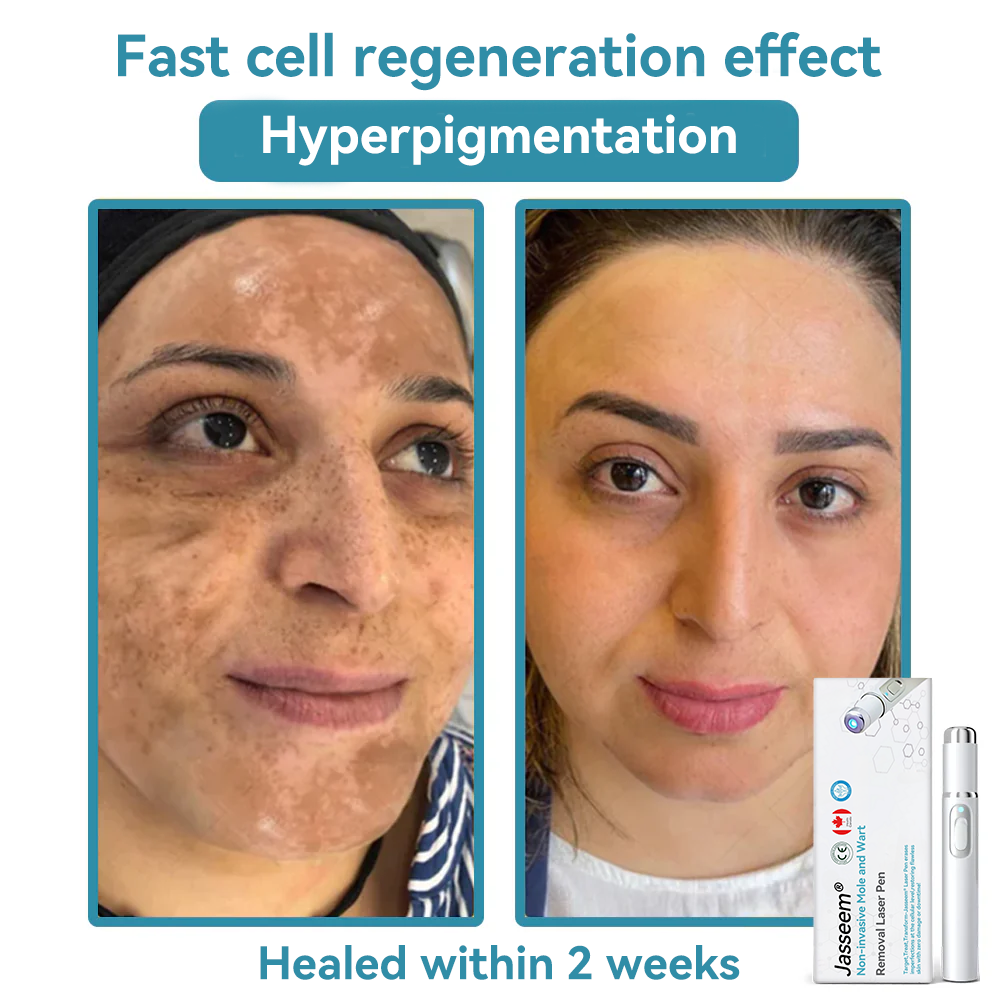 𝐉𝐚𝐬𝐬𝐞𝐞𝐦® Medical-Grade Laser Pen 🔥 (Powered by CO₂ laser technology – effectively removes moles, warts, skin tags, pigmentation spots, and other skin imperfections)🏆