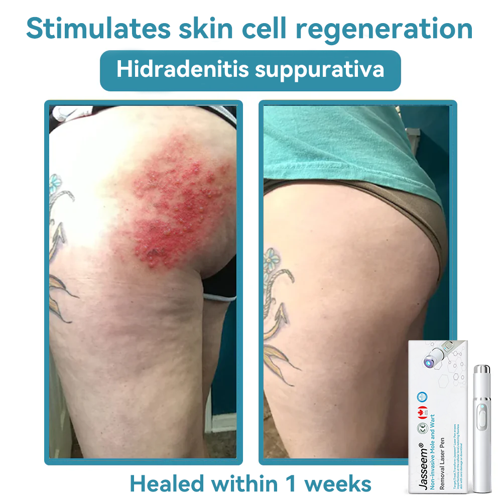 𝐉𝐚𝐬𝐬𝐞𝐞𝐦® Medical-Grade Laser Pen 🔥 (Powered by CO₂ laser technology – effectively removes moles, warts, skin tags, pigmentation spots, and other skin imperfections)🏆